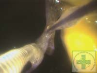 Эндоскопическое удаление инородного тела из желудка у лабрадора