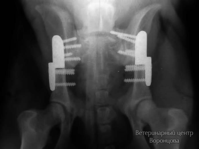 После проведения одномоментной двусторонней тройной остеотомии таза. На рентгене определяется норма.