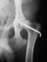 Рентгенограмма после фиксации вывиха ТБС