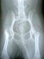 Рентгенограмма после резекционной артропластики.